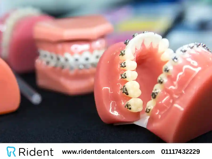 انواع تقويم الاسنان ، وأي الانواع مناسبة للحامل؟